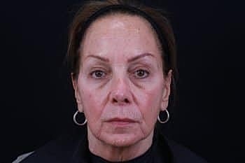 Dermal Fillers Before & After