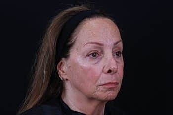 Dermal Fillers Before & After