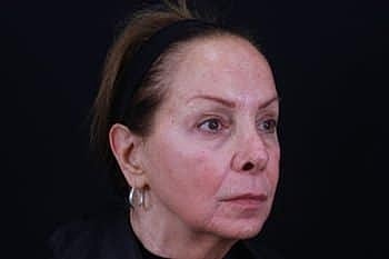 Dermal Fillers Before & After