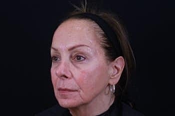 Dermal Fillers Before & After