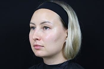 Dermal Fillers Before & After