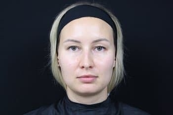Dermal Fillers Before & After