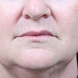 Dermal Fillers Before & After