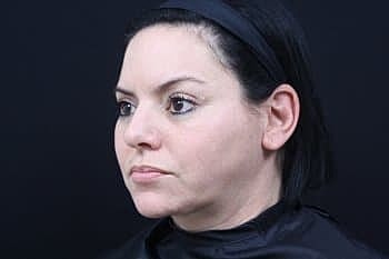 Dermal Fillers Before & After