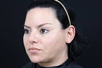Dermal Fillers Before & After