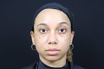Dermal Fillers Before & After