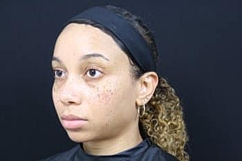 Dermal Fillers Before & After