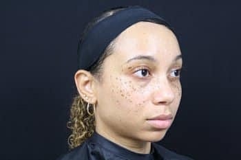 Dermal Fillers Before & After