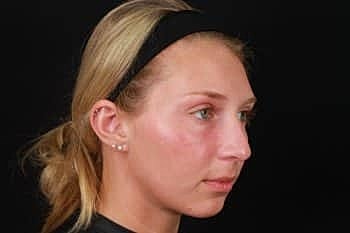 Dermal Fillers Before & After