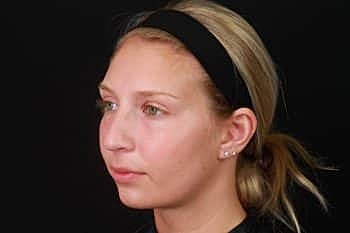 Dermal Fillers Before & After