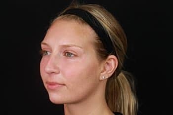 Dermal Fillers Before & After