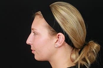 Dermal Fillers Before & After