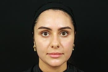 Dermal Fillers Before & After