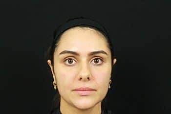 Dermal Fillers Before & After