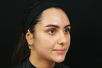 Dermal Fillers Before & After