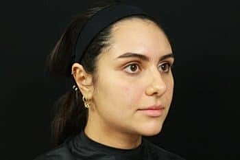 Dermal Fillers Before & After