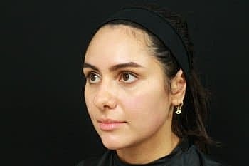 Dermal Fillers Before & After
