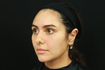 Dermal Fillers Before & After