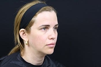 Dermal Fillers Before & After
