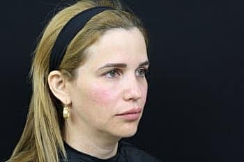 Dermal Fillers Before & After