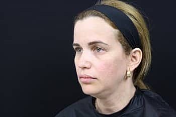 Dermal Fillers Before & After