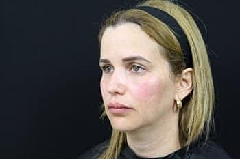 Dermal Fillers Before & After