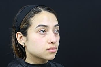 Dermal Fillers Before & After
