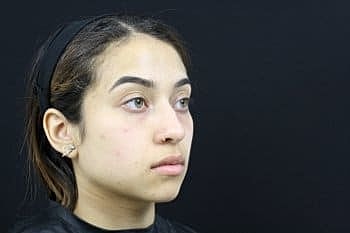 Dermal Fillers Before & After
