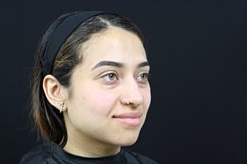 Dermal Fillers Before & After