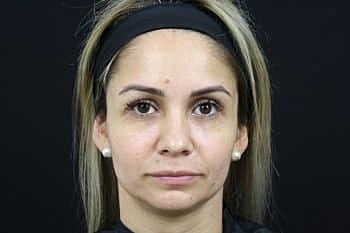 Dermal Fillers Before & After