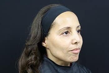 Dermal Fillers Before & After