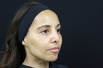 Dermal Fillers Before & After