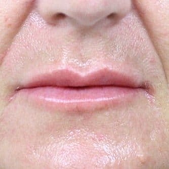 Dermal Fillers Before & After