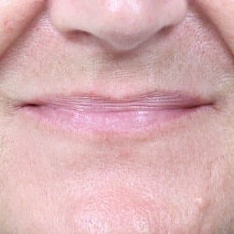Dermal Fillers Before & After