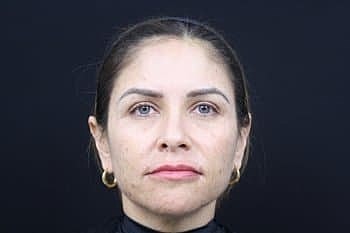 Dermal Fillers Before & After