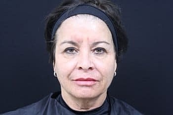 Dermal Fillers Before & After