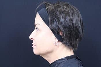 Dermal Fillers Before & After