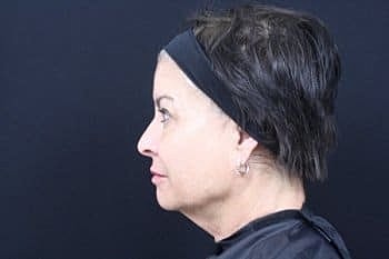 Dermal Fillers Before & After