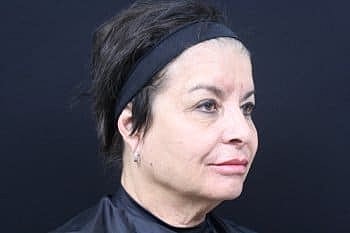 Dermal Fillers Before & After