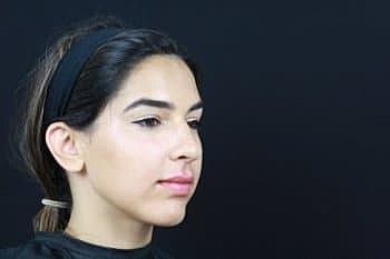 Dermal Fillers Before & After