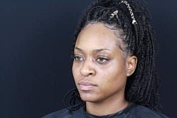 Dermal Fillers Before & After