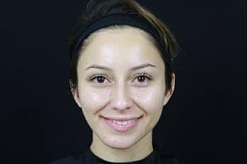 Dermal Fillers Before & After