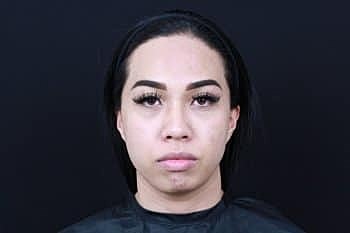 Dermal Fillers Before & After