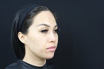 Dermal Fillers Before & After