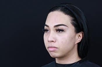 Dermal Fillers Before & After