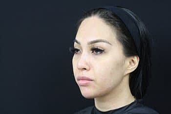 Dermal Fillers Before & After