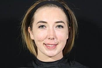 Dermal Fillers Before & After