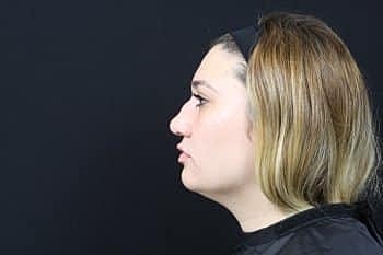 Dermal Fillers Before & After