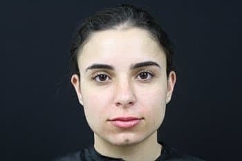 Dermal Fillers Before & After