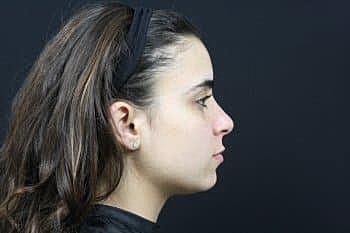 Dermal Fillers Before & After